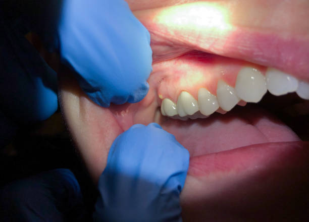 Best Emergency Broken Tooth Repair in Hicksville, NY